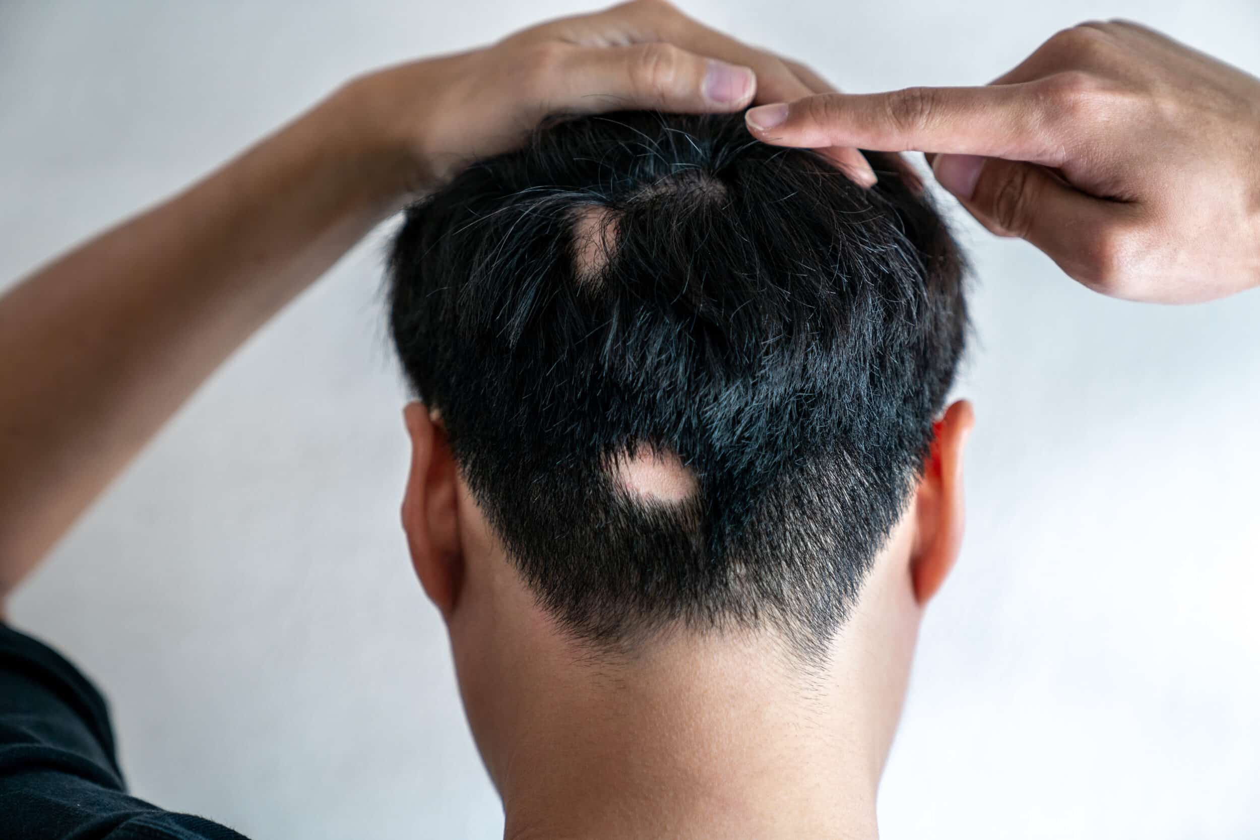 Man with multiple bald spots who is suffering from Alopecia Areata